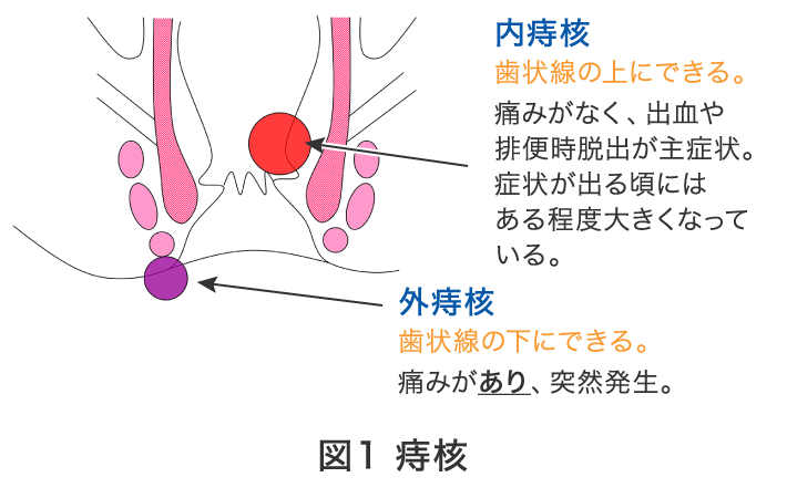 図1 痔核