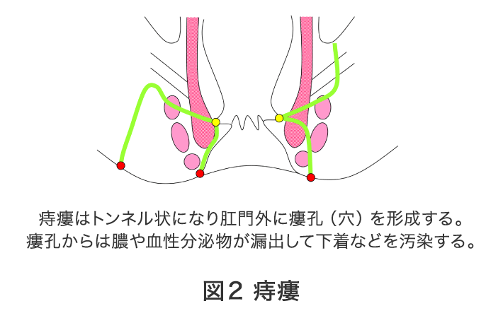 図2 痔瘻