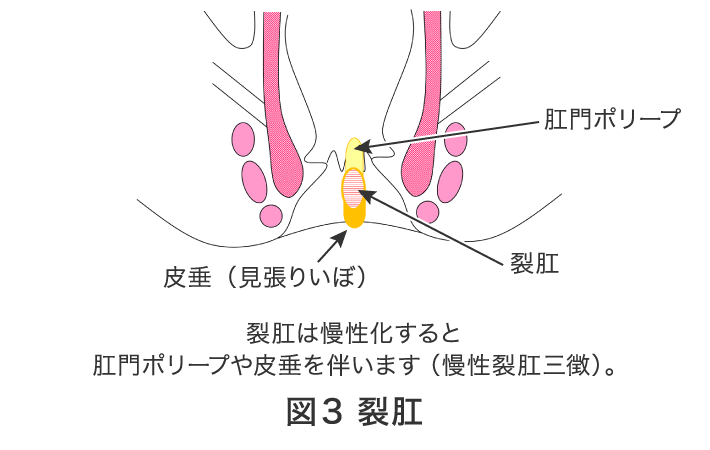 図3 裂肛