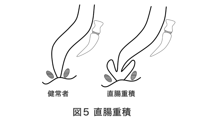 図5 直腸重積