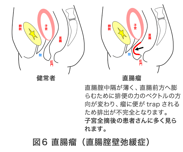 図6 直腸瘤（直腸膣壁弛緩症）