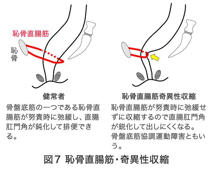 図7 恥骨直腸筋・奇異性収縮